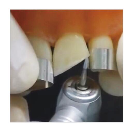 Steel Matrice Bands image 1