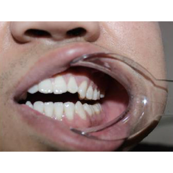 Hand-held Cheek Retractor 2 pcs/ pk image 1